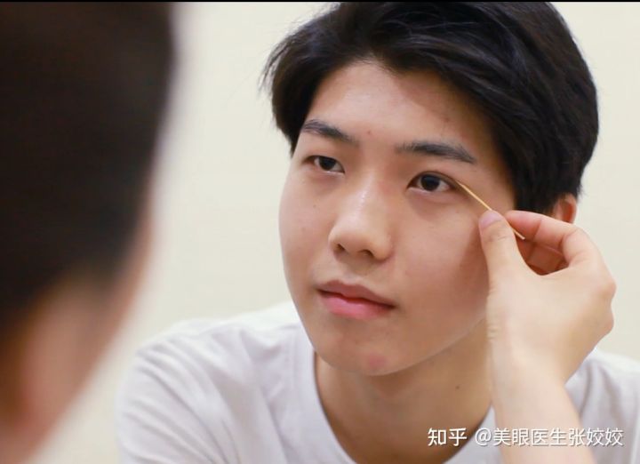 男生做双眼皮是全割还是埋线,男生肉眼泡双眼皮手术