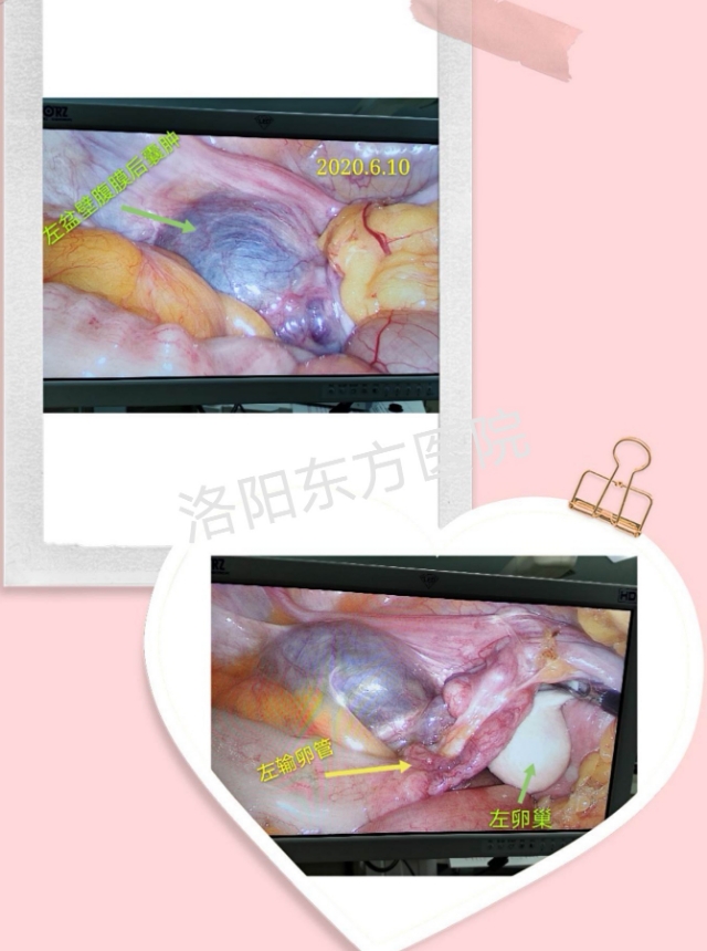 盆腔囊肿要复查吗,盆腔囊性占位灶建议复查