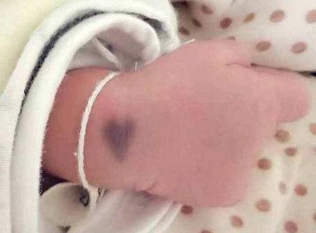 宝宝屁股上淤青怎么回事,宝宝屁股的淤青什么时候会消