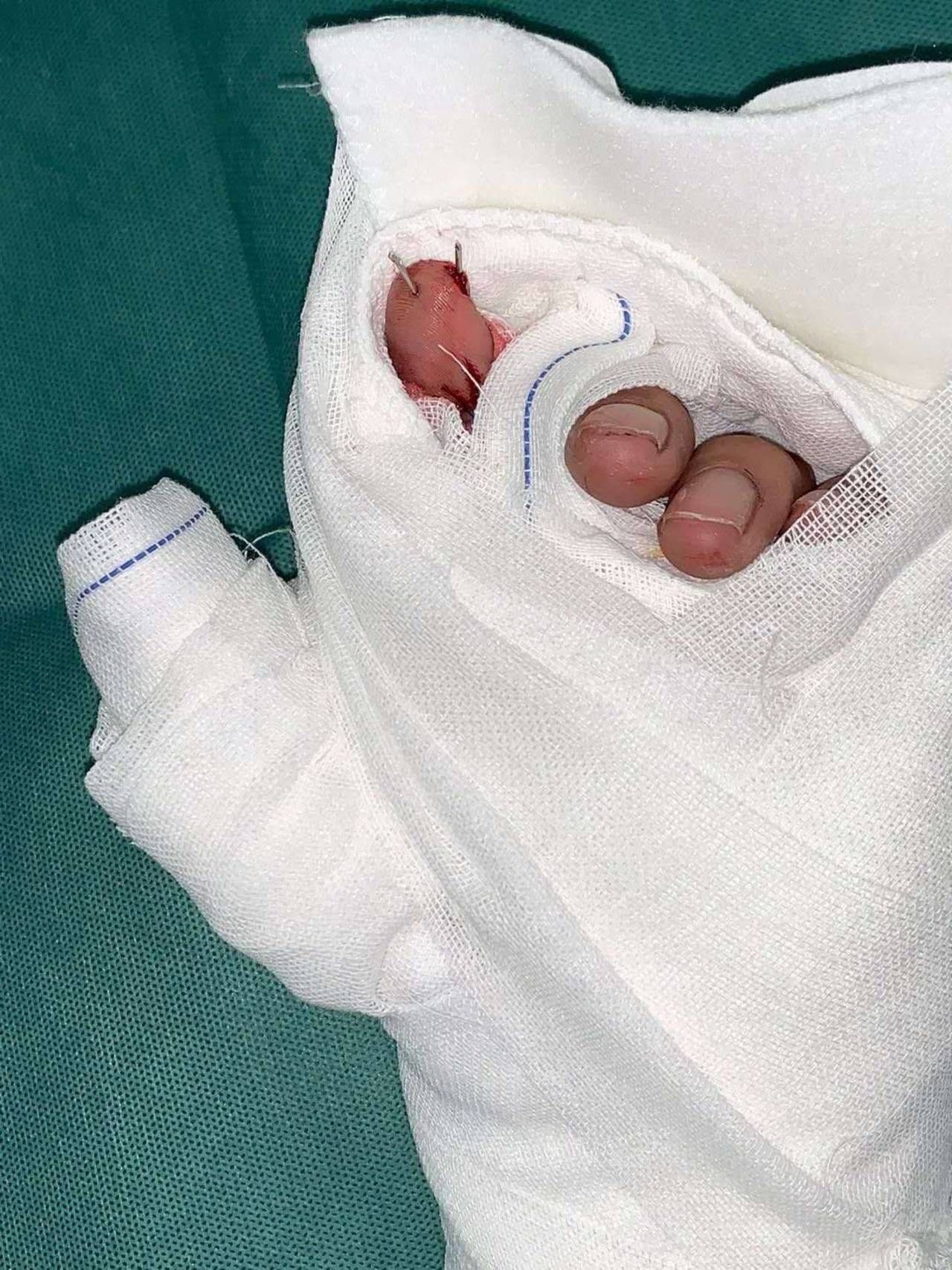 饱满红润！29岁木匠手指被切断 医生4小时再植成活