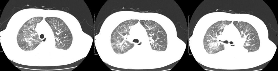 这例患者差点误诊为CAP，类似病变应如何逃离误诊「高发区」？