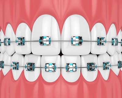 下牙不整齐如何自动矫正不戴牙套,半口牙矫正下排牙缝大