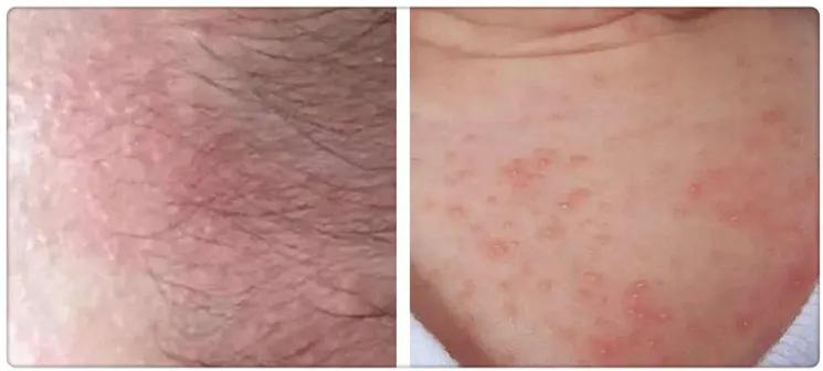 爽身粉去痱子,爽身粉止痒祛痱成人