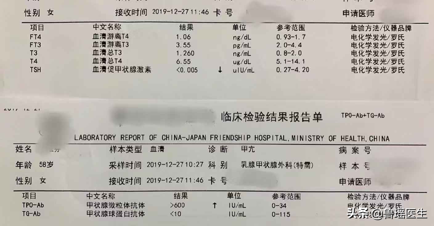 甲亢用过碘131还会复发吗,甲亢用碘131治疗好的患者案例