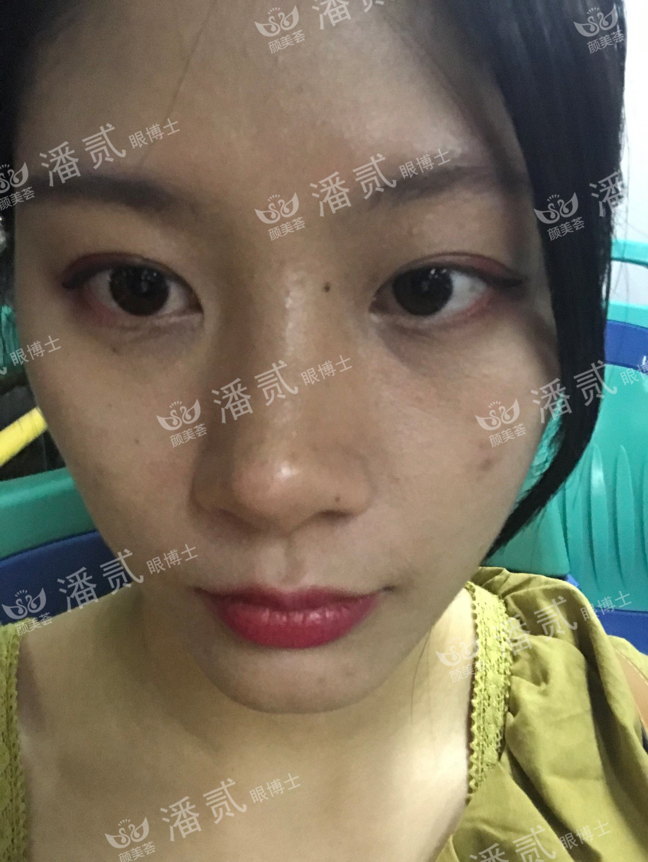 肿眼泡抽脂肪埋线双眼皮效果,肿眼泡割双眼皮长脂肪