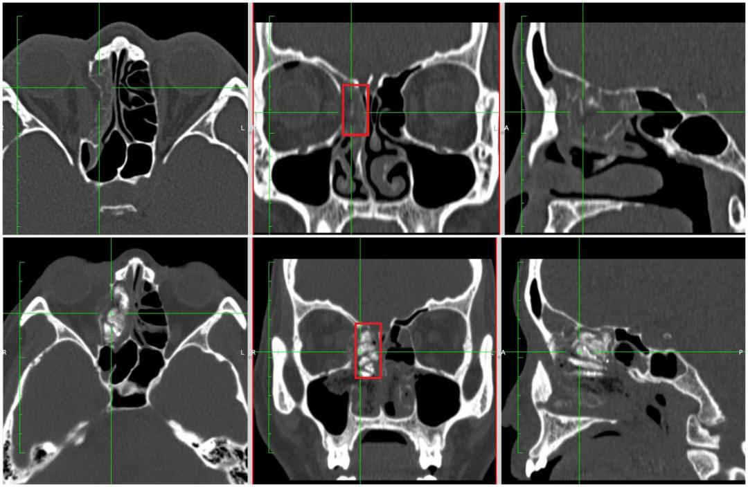 眼眶骨折治疗前的注意事项,眼眶骨折保守治疗需要注意什么