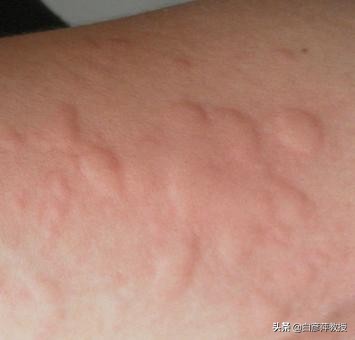 凸起的皮肤风团是什么,荨麻疹皮肤瘙痒警惕4种疾病