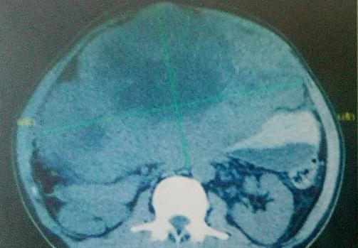 巨型肝癌晚期存活了5年,肝癌10厘米治愈案例