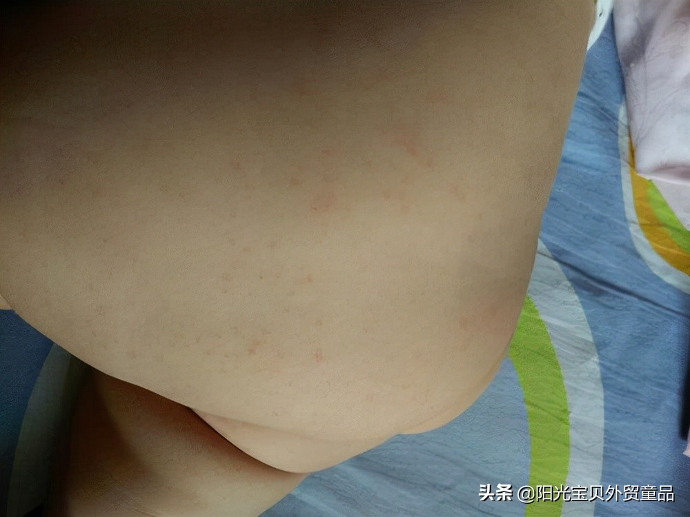 秋季宝宝湿疹怎么消除又快又好,秋季湿疹大爆发的原因
