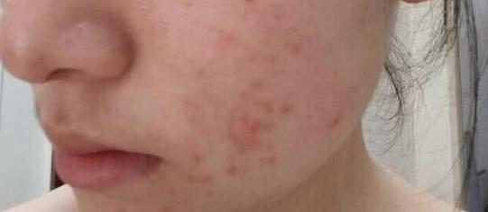 如何根据不同肤质挑选护肤品呢,角质层薄混合肤质用什么护肤品