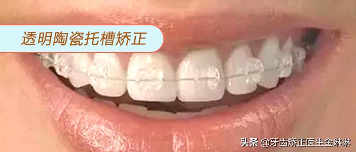 牙齿矫正舍不得给孩子拔牙,矫正牙齿不想戴牙套怎么办