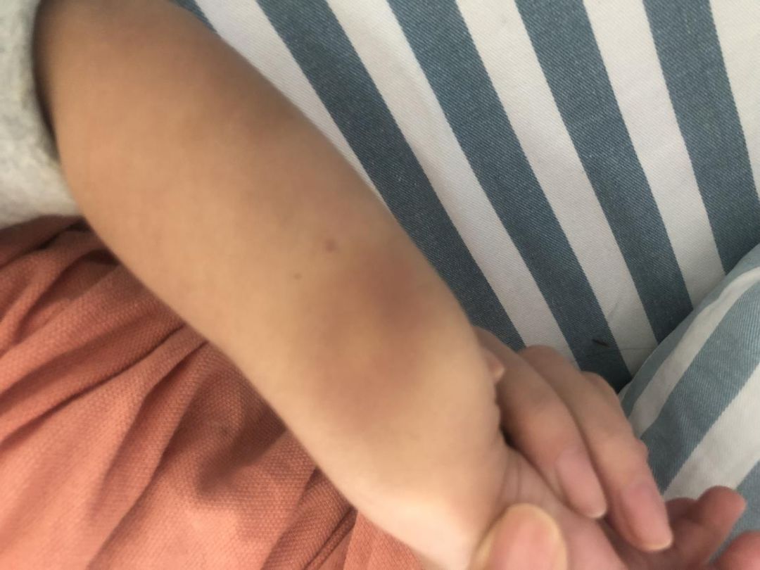 深圳2兄妹身上频现“离奇淤青”，医生：可能是吃出来的！咋回事？