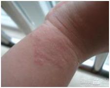 宝宝手指脱皮怎么办,夏天手指脱皮怎么办