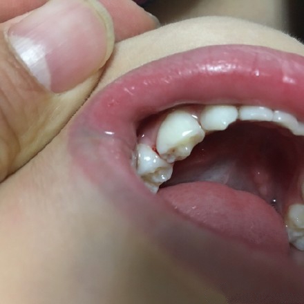 宝宝长牙牙龈痛怎么办吃什么药好,宝宝长牙牙龈肿痛怎样治疗