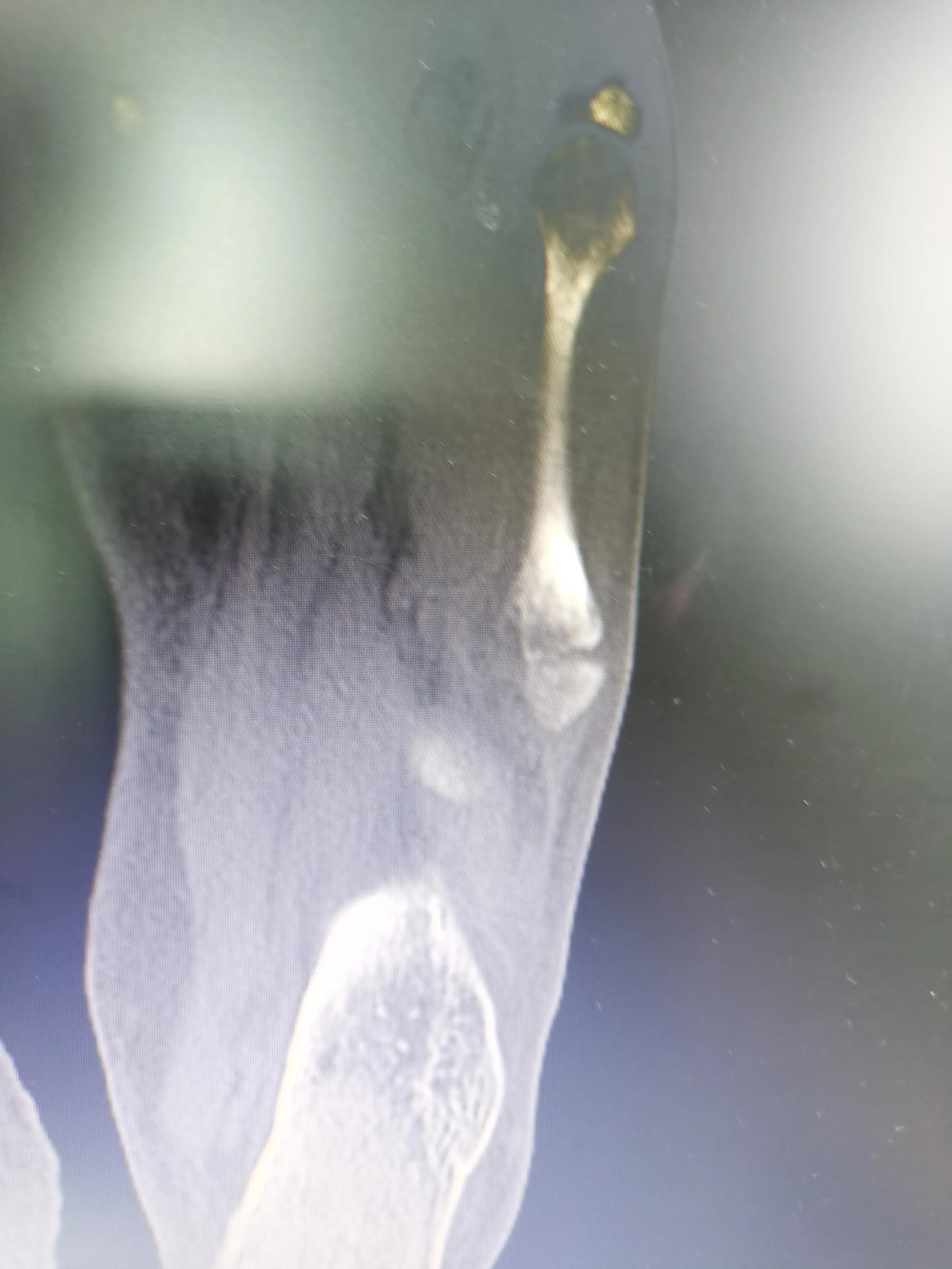 第五跖骨基底部骨折60天能走路吗,第五跖骨基底部骨折60天能脱拐吗