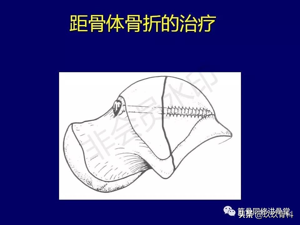 距骨骨折后遗症,距骨骨折怎么办