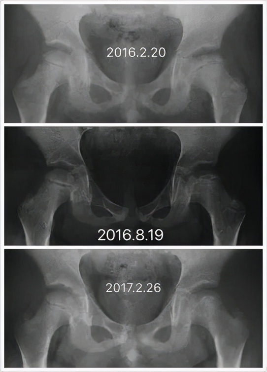儿童医院儿童骨科,儿童骨科专家讲解