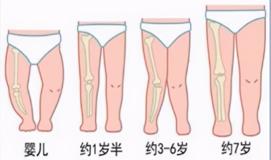 儿童肘内翻畸形,遗传右膝外翻畸形