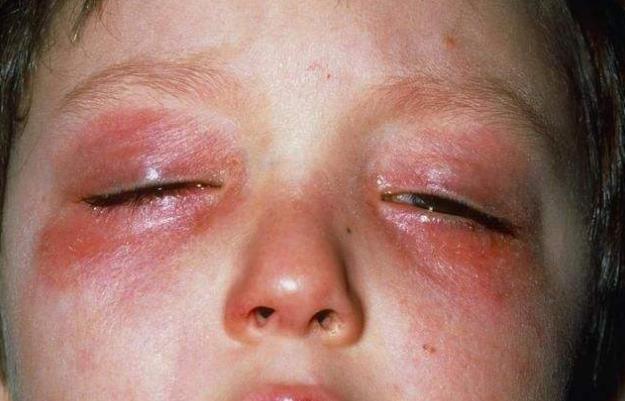 宝宝把水银体温计打碎了拿在手里,宝宝打碎水银温度计玩怎么办