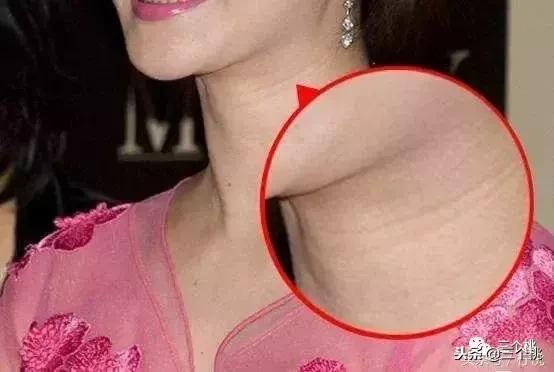 医美去颈纹全过程,去颈纹医美过程