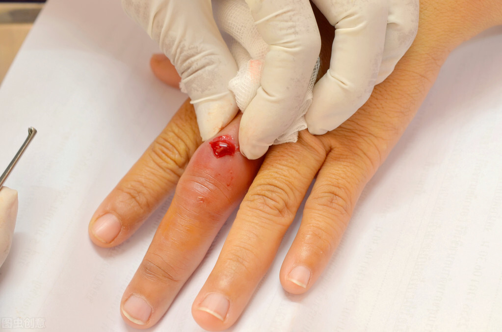 鱼刺扎了手需打破伤风针吗,鱼刺扎到手伤口不愈合