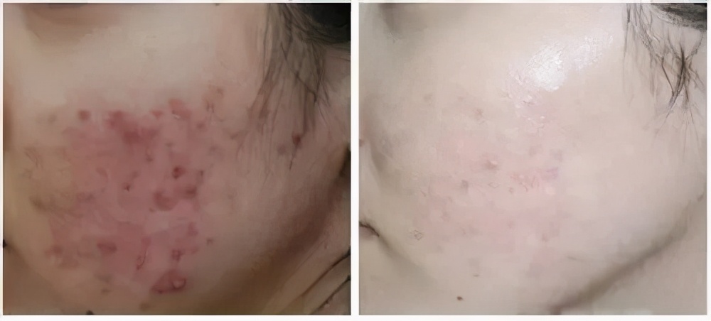 光子和超光子有什么区别,超光子比光子嫩肤贵吗