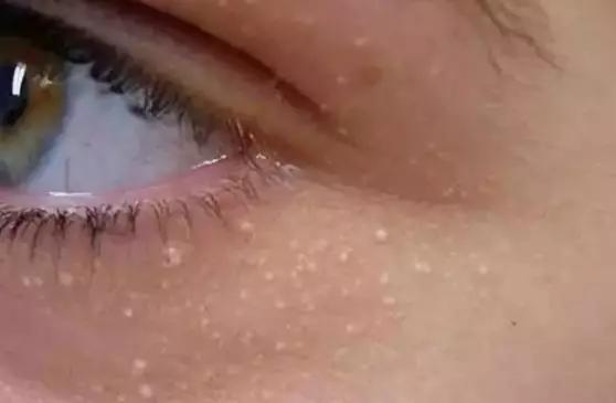 消除眼周脂肪粒最好方法,眼周有脂肪粒用什么眼霜