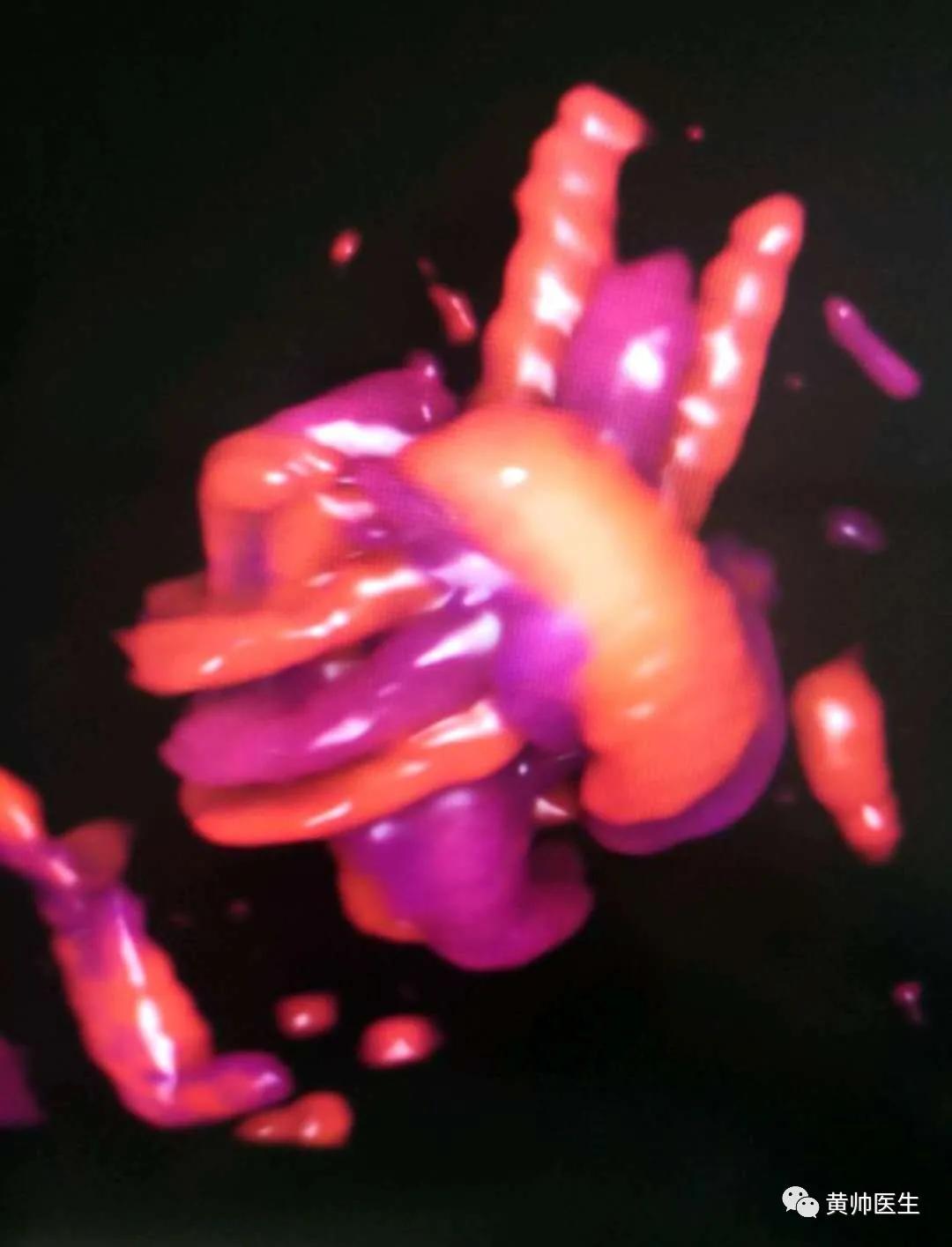 脐带疑似打结,脐带打结科普视频