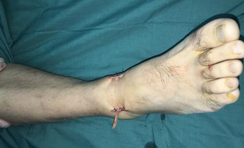 打球扭伤脚踝可以贴膏药吗,打篮球脚踝扭伤骨折大概多久痊愈