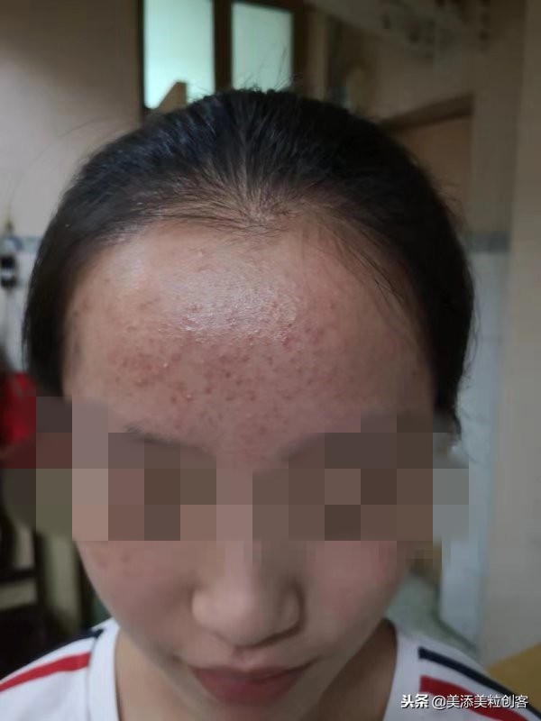 肠胃湿热症导致的闭口开口粉刺痘,这样对症而治少走很多弯路!