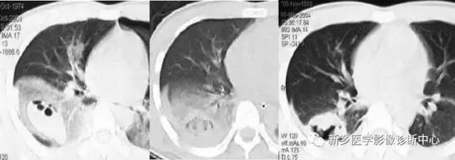肺部有球形病灶怎么治疗,肺内多发结节诊断早期肺癌怎么办