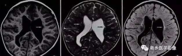 什么引起成人脑室扩大,哪些病可以导致左侧脑室增宽