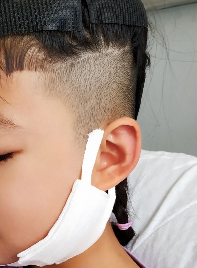 骨髓炎女儿,下颌骨骨髓炎是什么原因引起的