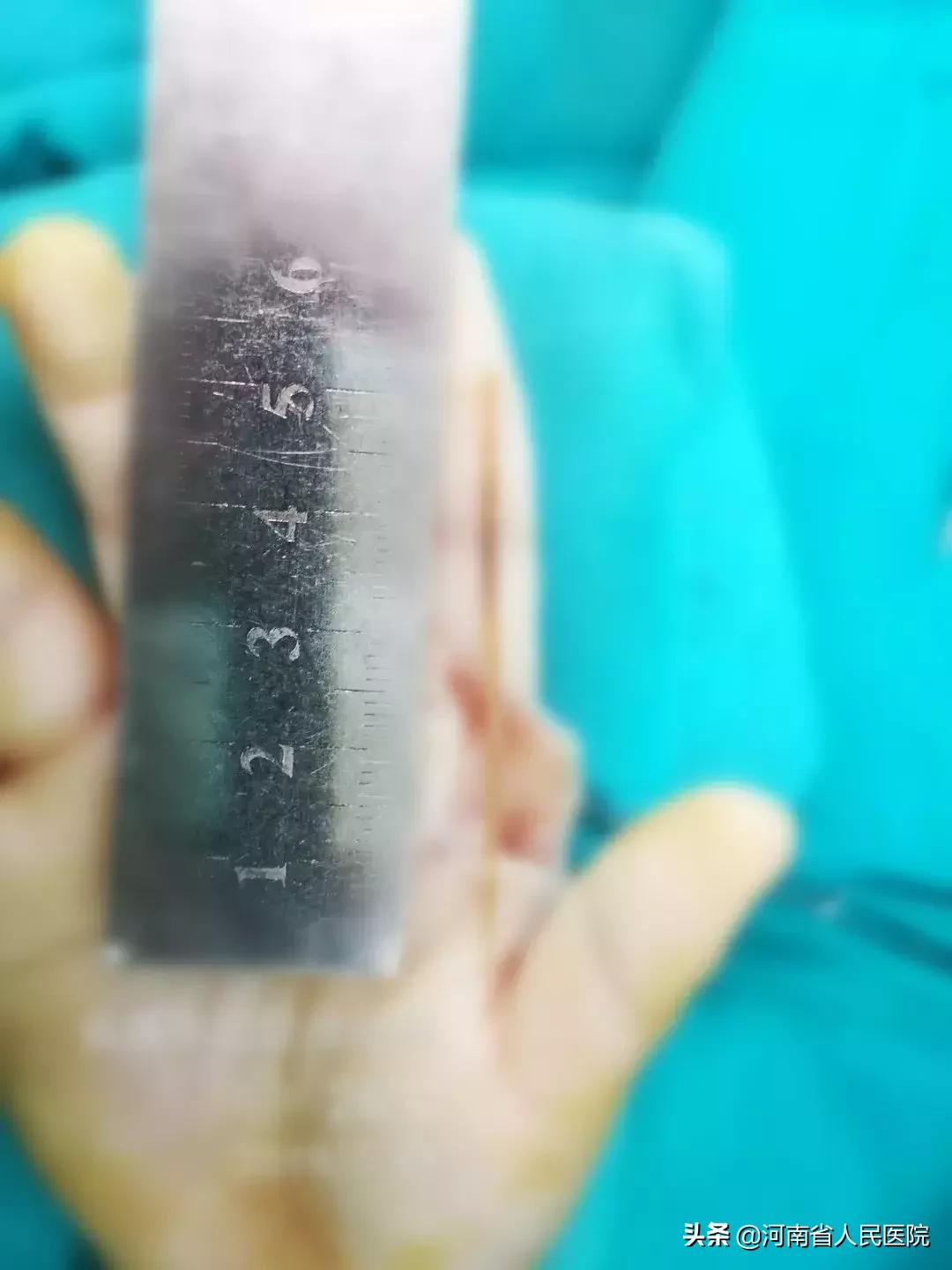 儿童竹签扎进嘴,竹签扎到小孩图片