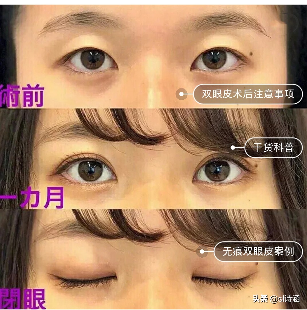 做完双眼皮后的注意事项,做完双眼皮过后应该注意些什么