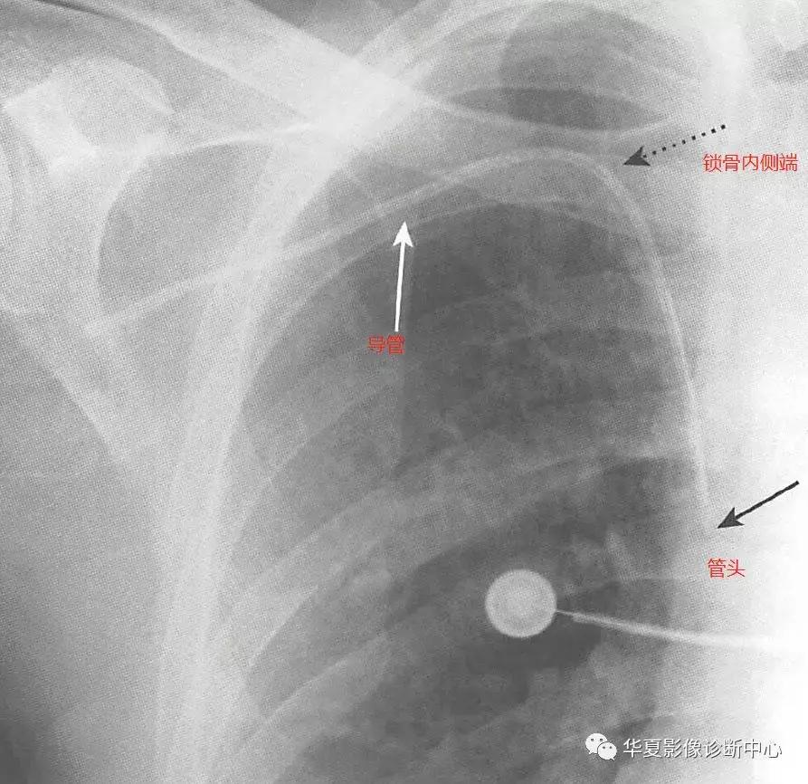 胸部x线影像与诊断基础,胸部置管
