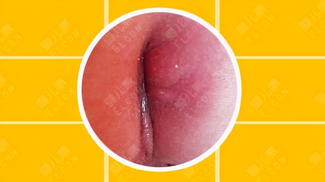 预防肛周脓肿打什么疫苗,孩子得了肛周脓肿还能接种疫苗吗