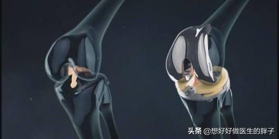 辟谣膝关节,年轻人膝盖有骨刺能根治吗