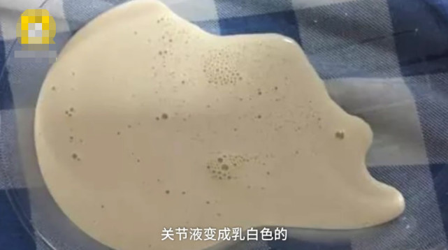 29岁男子关节抽出牛奶色液体,天天喝啤酒一天最多喝10瓶