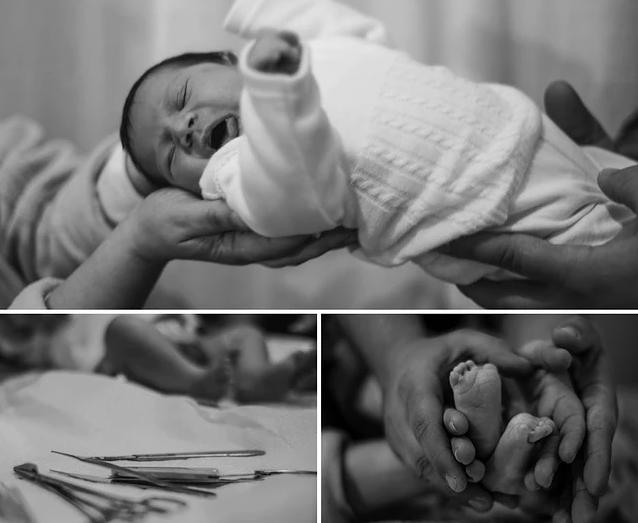 初到人间的宝宝,男宝包皮过长什么时候治疗