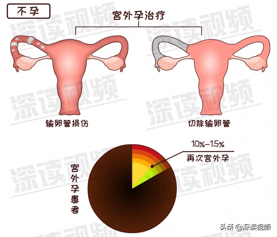 关爱女性|3.8妇女节深读特别节目——《宫外孕专题》