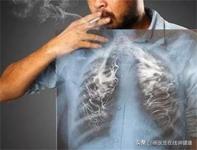 2厘米肺结节打消炎针能变小吗,肺结节5mm一年后去检查变小