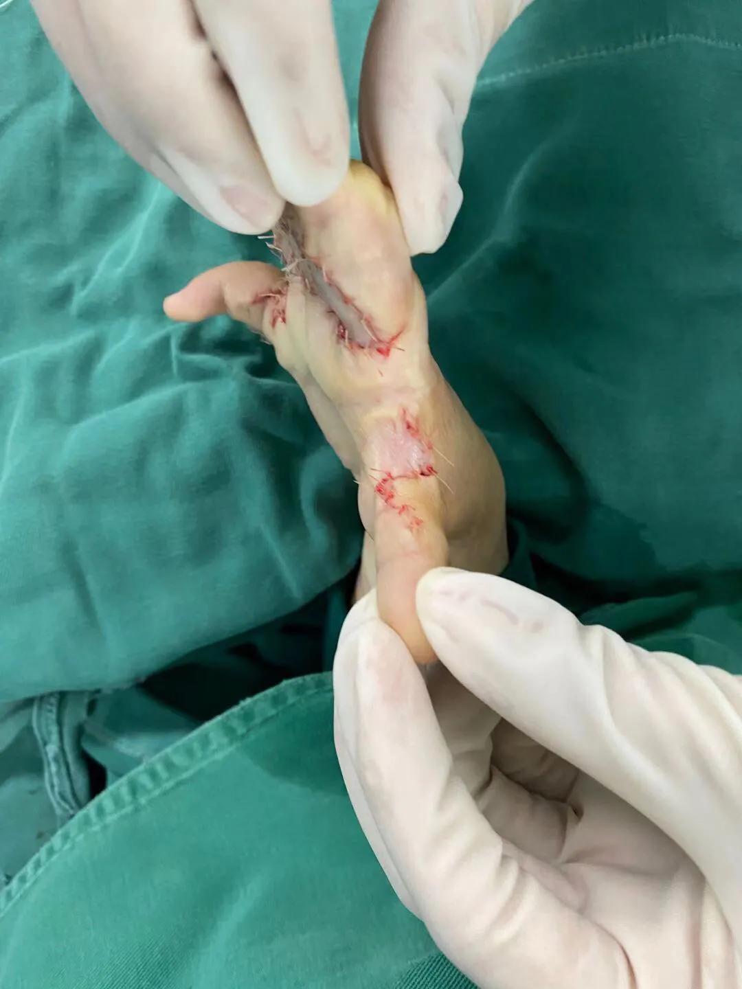 儿童烫伤的疤痕,三度烫伤疤痕为啥挛缩