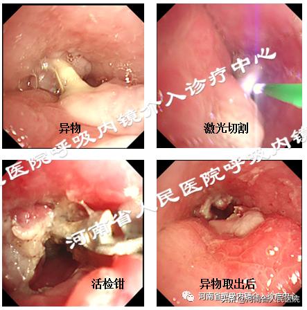 不小心吃进甲鱼骨头,不小心吃了甲鱼骨头
