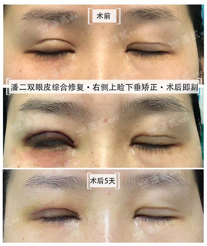 双眼皮术后恢复不一致正常吗,双眼皮术后看着不对称