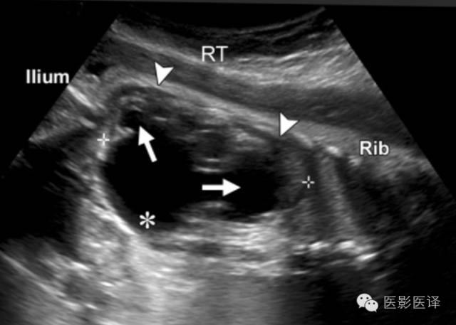 孕期发现卵巢囊肿有8cm左右,孕19周查出胎儿卵巢囊肿