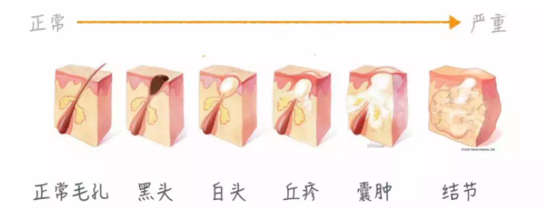 根治黑头的最佳方法,怎么才能彻底治好黑头