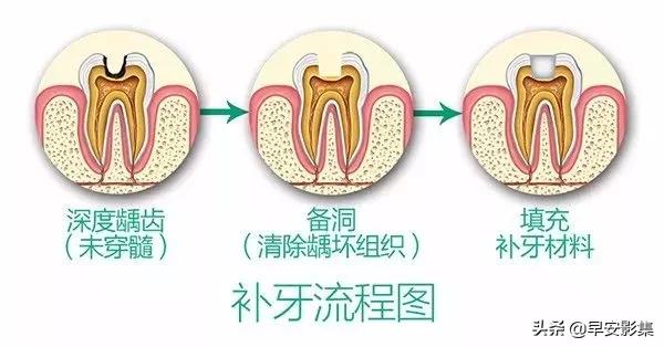 牙医补牙有区别吗,什么叫补牙什么叫种牙