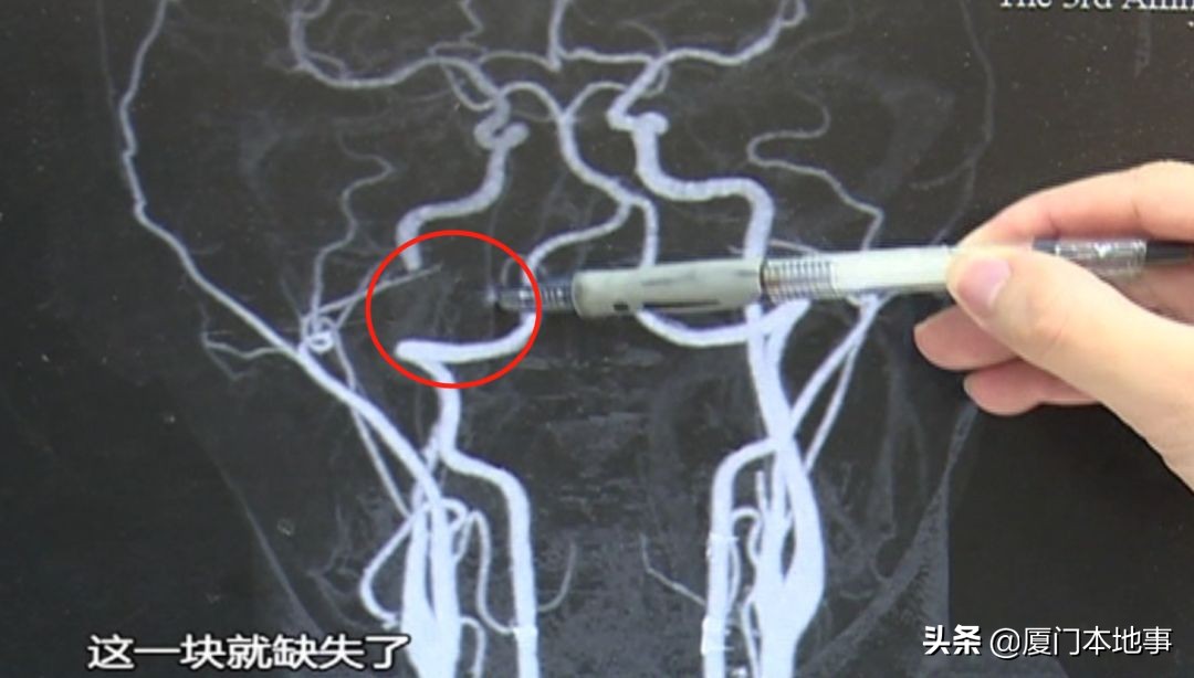 家门口按摩刮痧后,36岁男子脑梗!这个部位真的不能随便按
