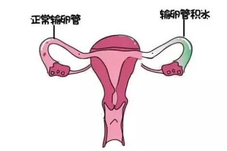 输卵管积水最严重是怎样的,输卵管积水和卵巢囊肿区别